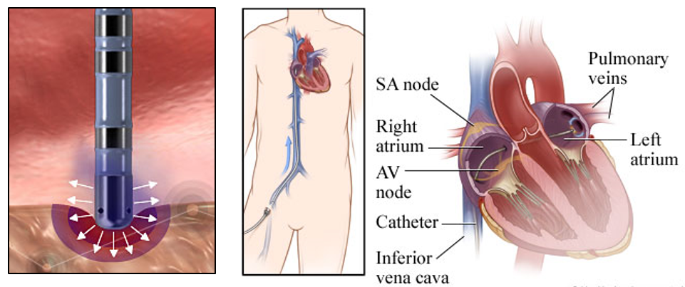 ablacia